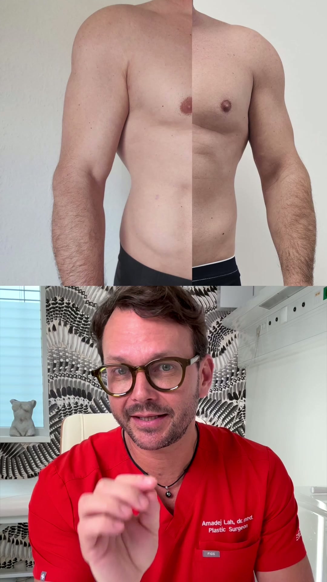 Liposuzione HD del corpo: definizione precisa dei contorni muscolari e uso del grasso autologo
